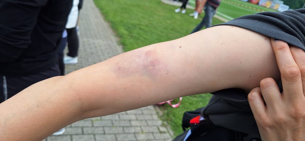 Stolz werden die blauen Flecken präsentiert